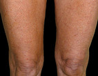 After Thermage body - Knees